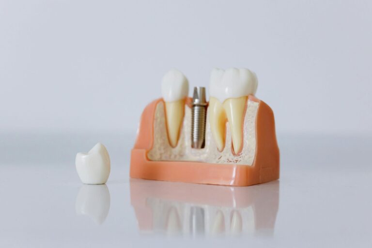 Bone Grafting Before Dental Implants: What Patients Should Know Bone Grafting Before Dental Implants